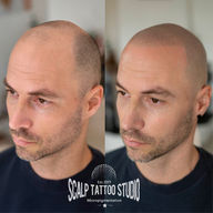 tetovanie vlasov smp mikropigmentácia hair tattoo