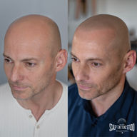 tetovanie vlasov hair tattoo smp mikropigmentácia