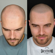 tetovanie vlasov hair tattoo smp mikropigmentácia