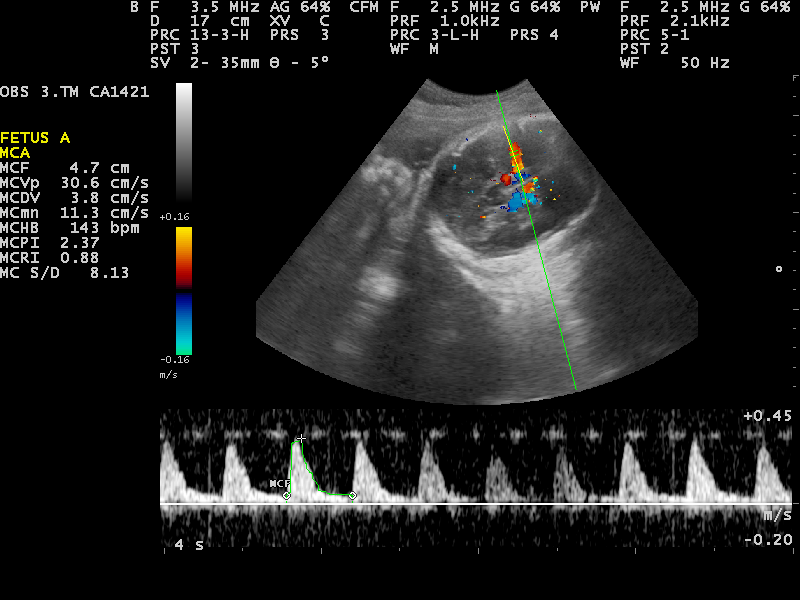 Para que sirve la ecografia doppler obstetrica