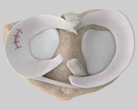 Meniscus repair London | Essex
