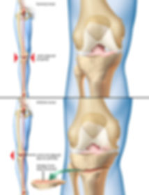 Knee Osteotomy