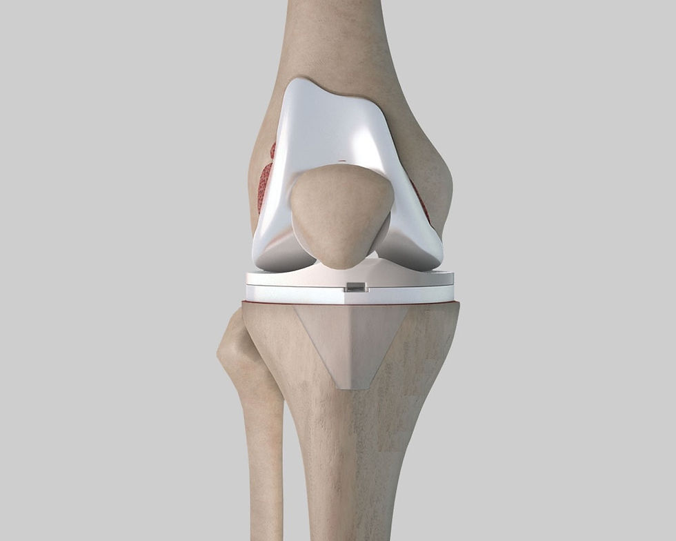 Total knee replacement