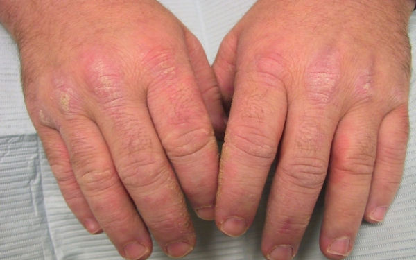 Biểu hiện ngoài khớp trong viêm khớp phản ứng: viêm mắt, niệu đạo và tổn thương da