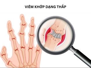Viêm khớp dạng thấp: Nguyên nhân, triệu chứng và cách điều trị hiệu quả