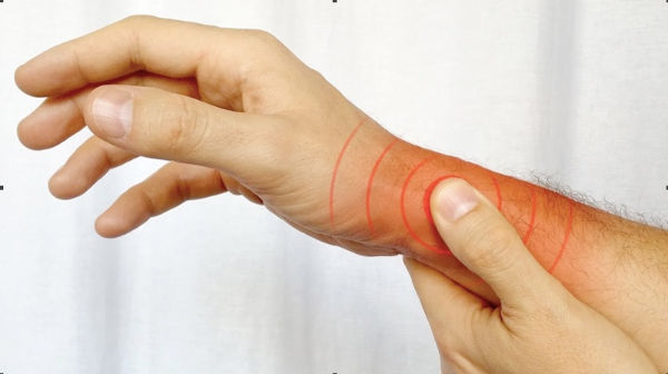 Đau xuất hiện dần dần hay đột ngột ở vùng gốc ngón tay cái, vùng mỏm trâm quay
