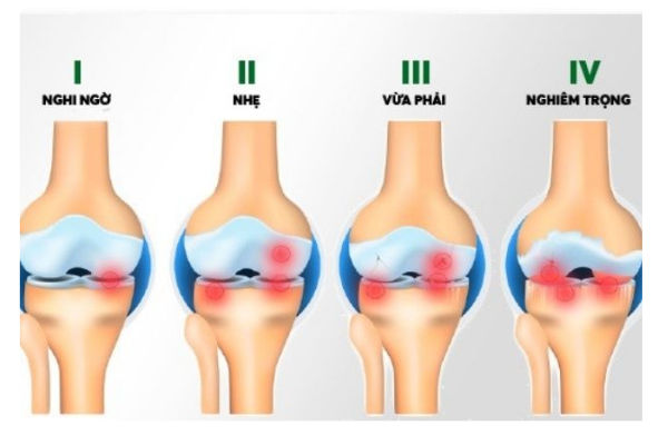 Các giai đoạn tiến triển của thoái hóa khớp gối.