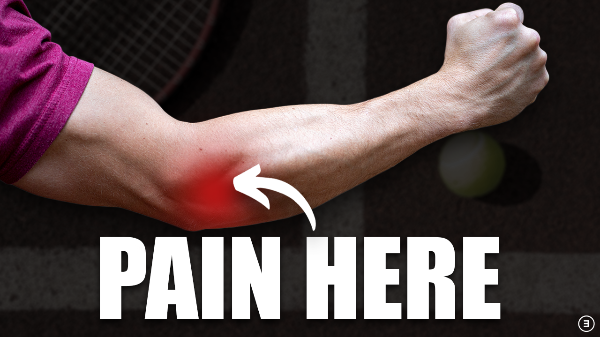 Vị trí đau lan từ khuỷu tay ra cổ tay – dấu hiệu điển hình của Tennis Elbow