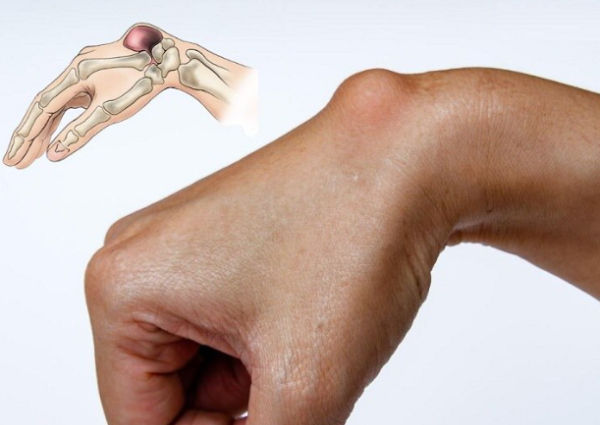 Cấu trúc khớp bình thường và khi bị viêm bao hoạt dịch – chất lỏng tích tụ làm sưng đau khớp.
