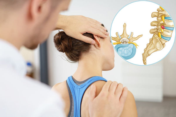 Vật lý trị liệu phục hồi chức năng cho thoát vị đĩa đệm cột sống cổ