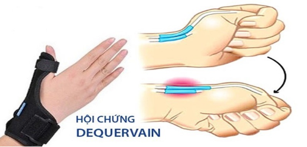 Hội chứng De Quervain là tình trạng viêm chít hẹp bao gân dạng ngón cái dài và duỗi ngón cái ngắn ở vùng cổ tay