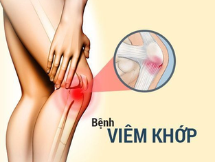 Viêm khớp: nguyên nhân, triệu chứng, chẩn đoán và phương pháp điều trị