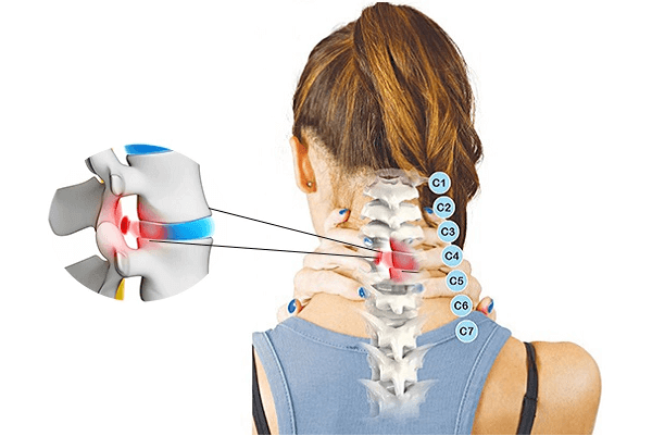 Thoát vị đĩa đệm cột sống cổ có thể gây đau đớn và ảnh hưởng đến chất lượng cuộc sống nếu không điều trị kịp thời.