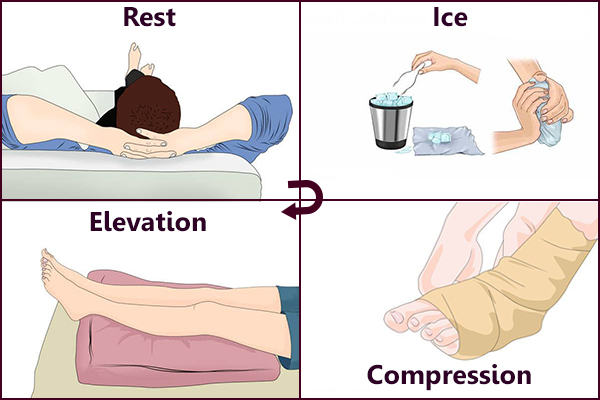 Áp dụng phương pháp R.I.C.E giúp kiểm soát tình trạng sưng nhanh chóng.