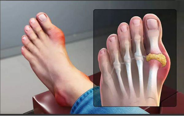 Khớp ngón chân cái sưng to, đỏ rực – biểu hiện điển hình của cơn gout cấp ở người cao tuổi.