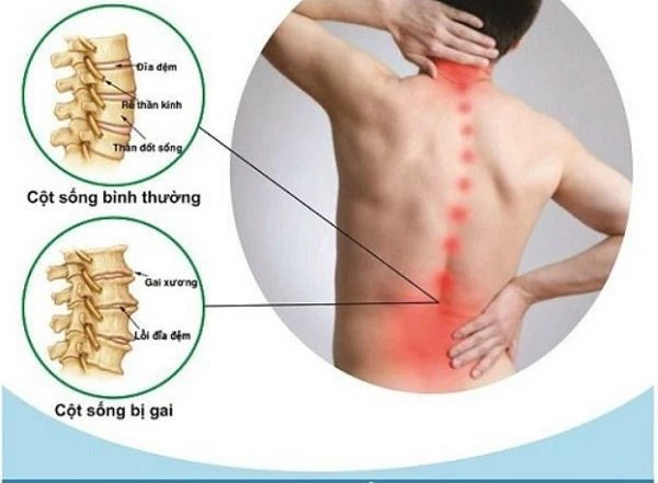 Vị trí đau lan từ vùng thắt lưng xuống chân trong trường hợp rễ thần kinh bị chèn ép do gai cột sống lưng