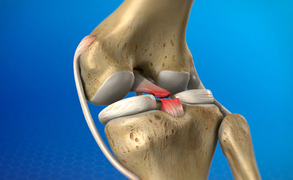 Đứt dây chằng chéo sau là tình trạng bị căng, rách hoặc đứt hoàn toàn dây chằng chéo sau đầu gối