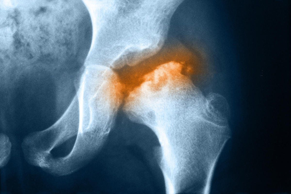 Bệnh Legg-Calve-Perthes xảy ra khi có quá ít máu được cung cấp đến phần đầu xương đùi