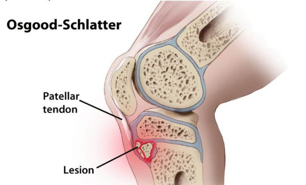Bệnh Osgood-Schlatter còn được gọi là bệnh viêm lồi củ trước xương chày