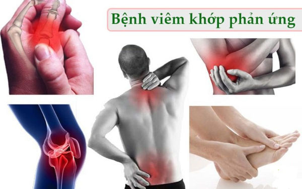 Cơ chế viêm khớp phản ứng xảy ra sau nhiễm khuẩn đường tiêu hóa hoặc tiết niệu.