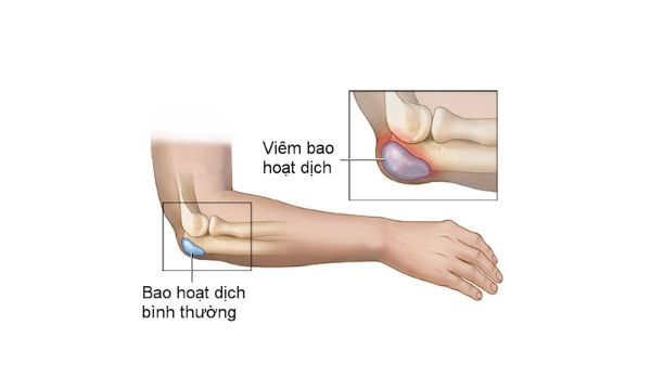 Viêm bao hoạt dịch vùng khuỷu tay – một vị trí dễ bị ảnh hưởng ở người lớn tuổi, đặc biệt khi tỳ đè lâu hoặc vận động lặp lại.