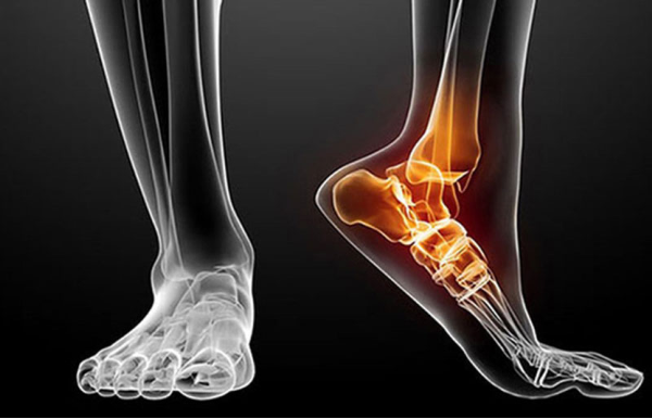Bệnh thoái hóa khớp cổ chân là gì?