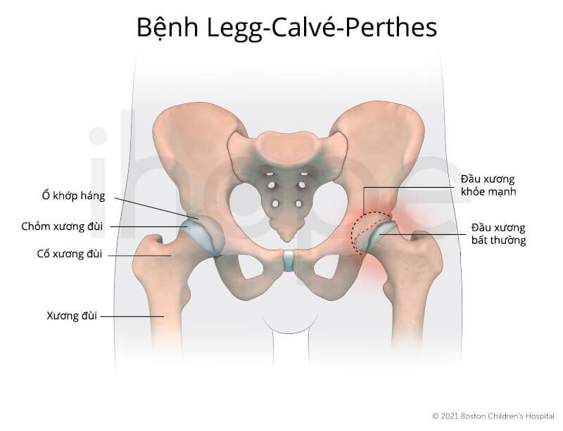 Bệnh Legg-Calvé-Perthes là một bệnh hoại tử xương sụn liên quan đến sự hoại tử vô khuẩn tự phát của chỏm xương đùi