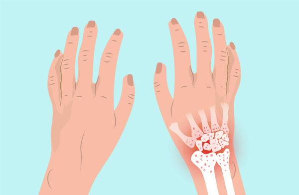 Các triệu chứng điển hình như đau, cứng khớp khiến người bệnh gặp khó khăn trong sinh hoạt.