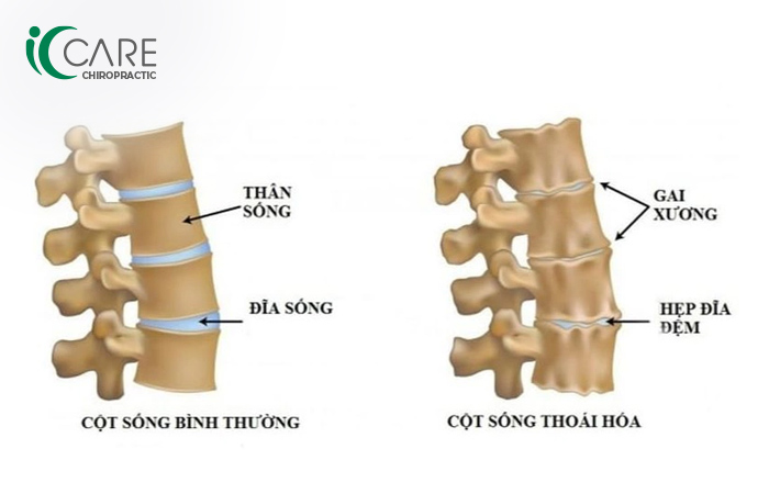 Thoái hóa đốt sống cổ làm hẹp không gian giữa các đốt sống, chèn ép dây thần kinh và mạch máu, gây đau nhức, chóng mặt, mất ngủ.