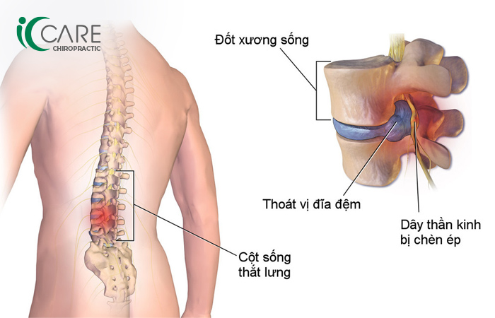 Thoát vị đĩa đệm chèn ép dây thần kinh gây đau nhức