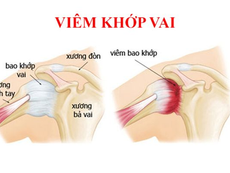 Viêm khớp vai có nguy hiểm không? Dấu hiệu, biến chứng và hướng điều trị hiệu quả
