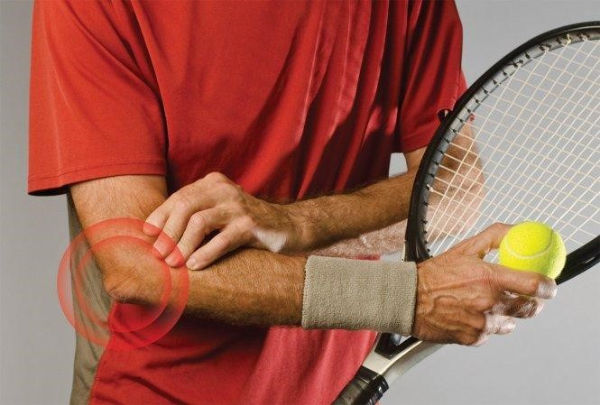 Vị trí gân bị viêm trong hội chứng Tennis Elbow – vùng lồi cầu ngoài khuỷu tay.