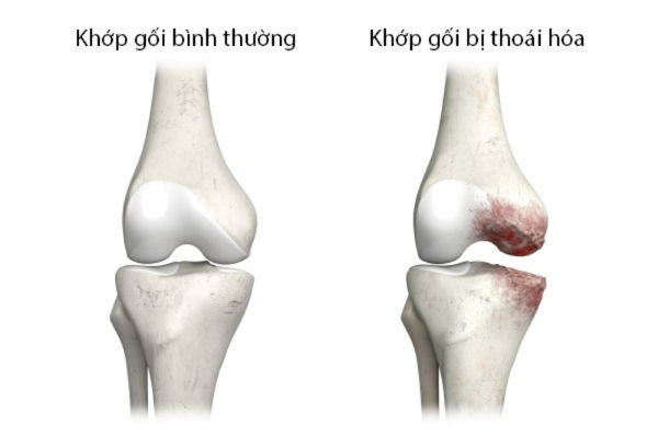 Thoái hóa khớp gối là một trong những dạng viêm khớp phổ biến nhất
