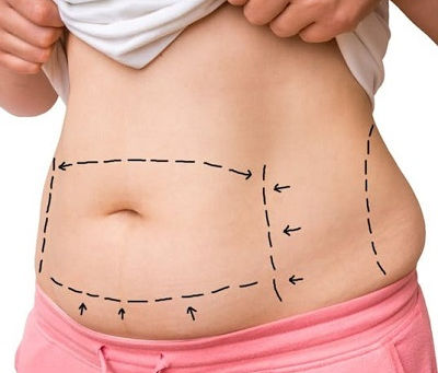 Tummy Tuck Recovery Mistakes Beginners Often Make