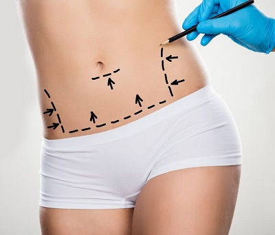 Liposuction and Body Image: What to Expect Emotionally After the Procedure