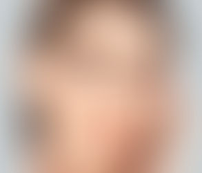 How Long Does Rhinoplasty Surgery Take?
