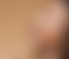 Rhinoplasty Myths You Should Stop Believing
