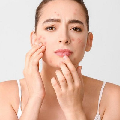 Best Acne Treatment in Muscat