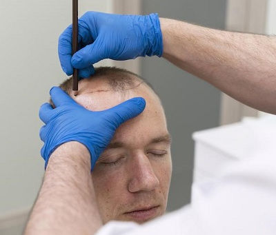 Cost Breakdown: FUT Hair Transplant in Oman