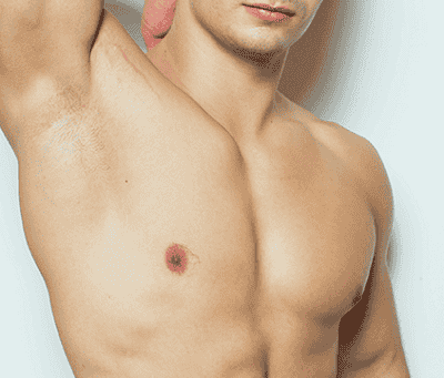 Gynecomastia Surgery in Your 20s, 30s, or 40s: Does Age Matter?