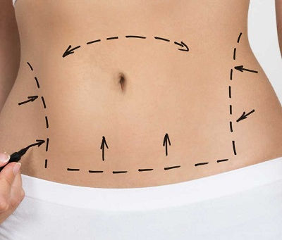 Do You Really Need a Tummy Tuck After Pregnancy?
