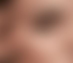 Before and After Eyelid Surgery: What Results Look Like