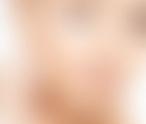 Before You Get Eyelid Surgery: 15 Essential Things to Know