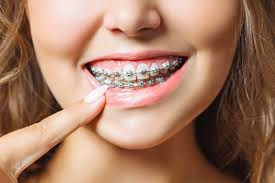 Invisible Braces: Top Choices for a Discreet Smile