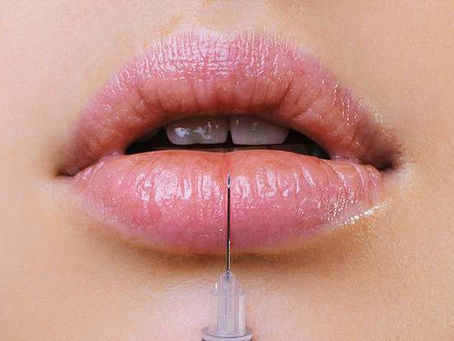 The Ultimate Guide to Choosing the Best Lip Fillers