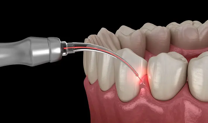 laser dentistry with laser light focusing gum region