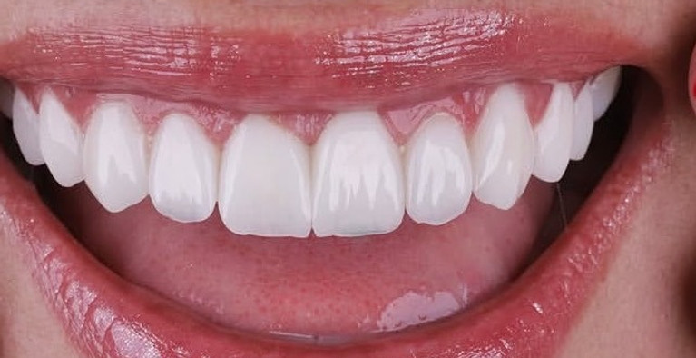 dental veneer