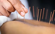 acupunture