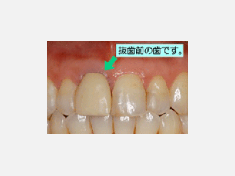 歯