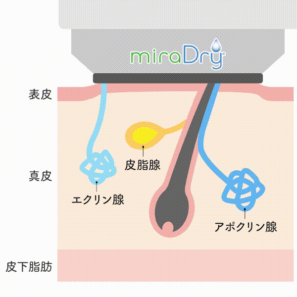 ミラドライ熱作用